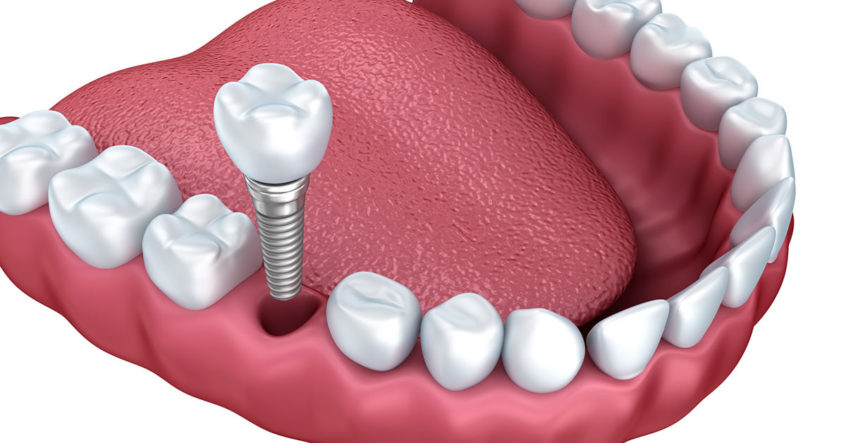 What Are the Popular Options for Replacing Missing Teeth? 